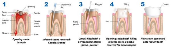 root canal diagram